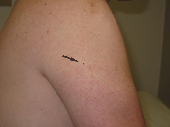 Upper arm Rt a arrow